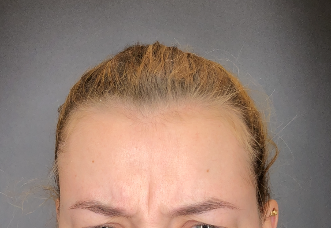 Žena · čelo a vráska mezi obočím – Před aplikaci botulotoxinu